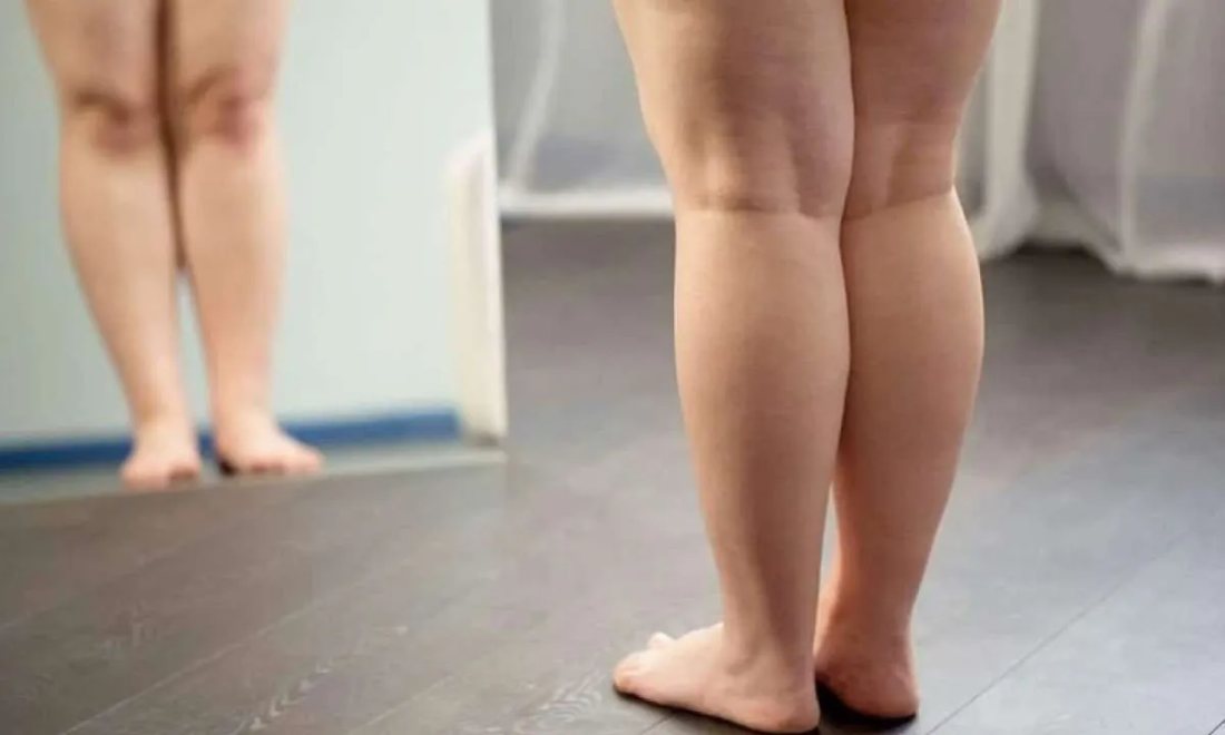 Pernas com sinais de lipedema